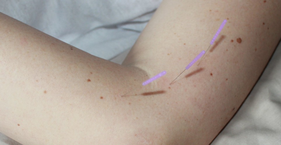 Dry needling Nepean