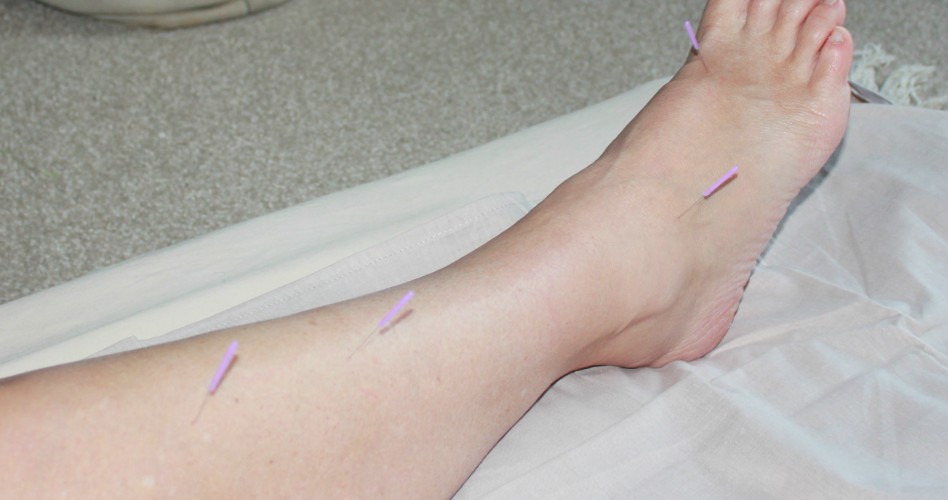 Dry needling Nepean